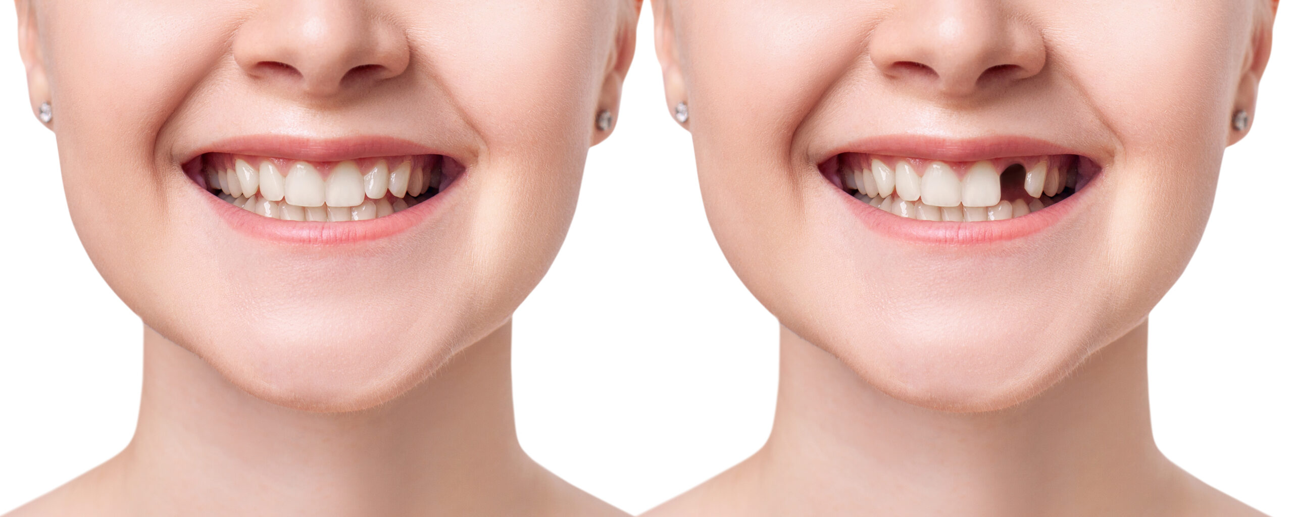 Young woman smiling before and after dental implant. ung woman smiling before and after dental implant. Isolated on white background.