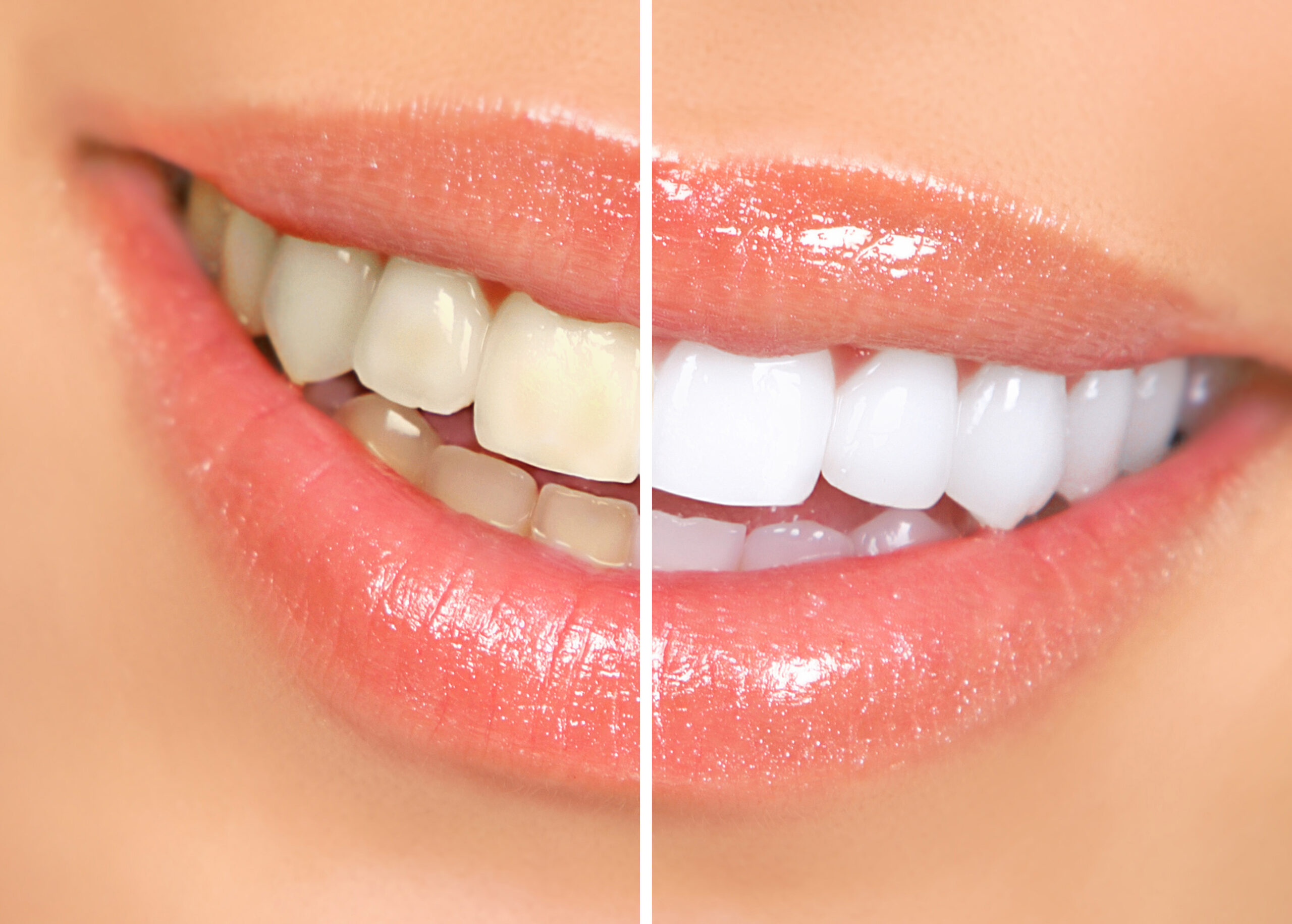 teeth whitening Mouth and teeth before and after whitening